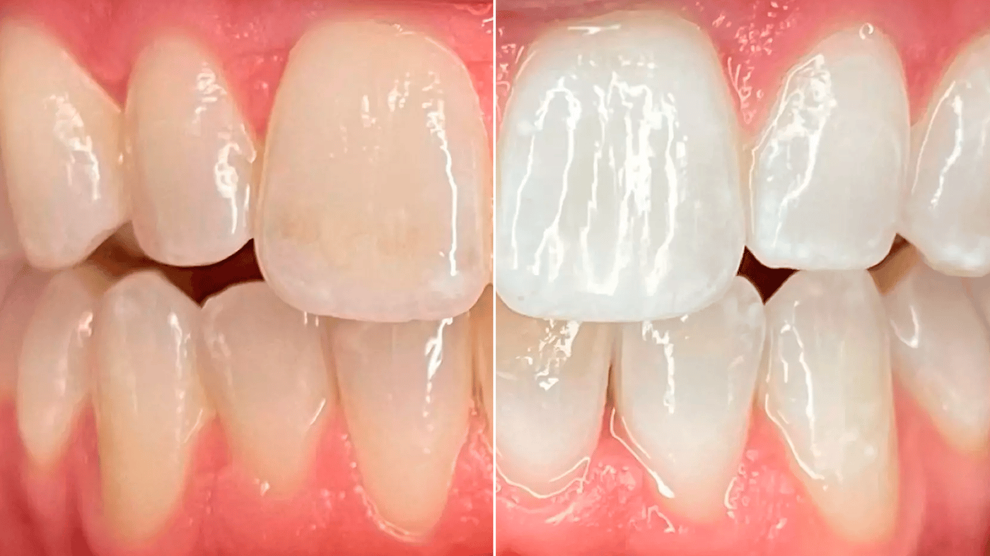Philips Zoom! whitening before and after result comparison